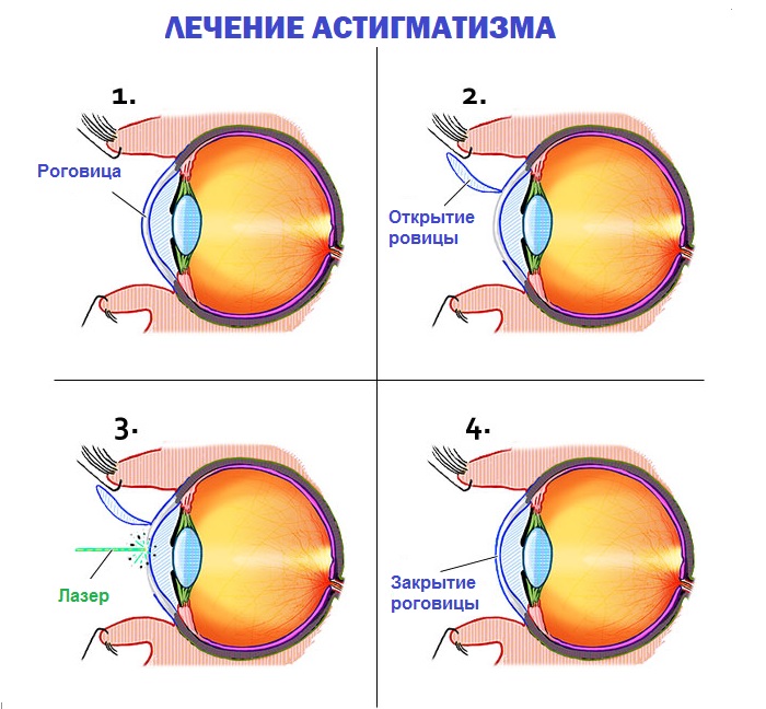 Хирургическое лечение Оперативное вмешательство