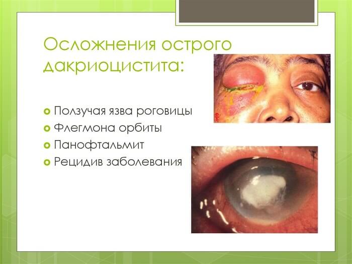 Осложнения дакриоцистита