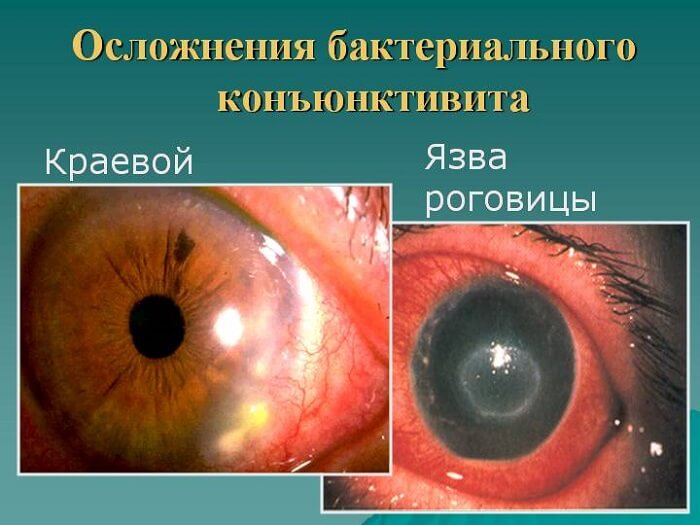Осложнения конъюнктивита