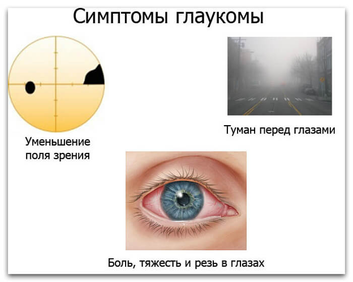 Основные признаки глаукомы