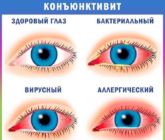 Основные разновидности конъюнктивита