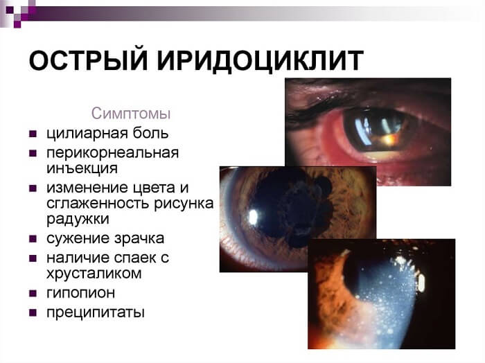 Основные симптомы иридоциклита