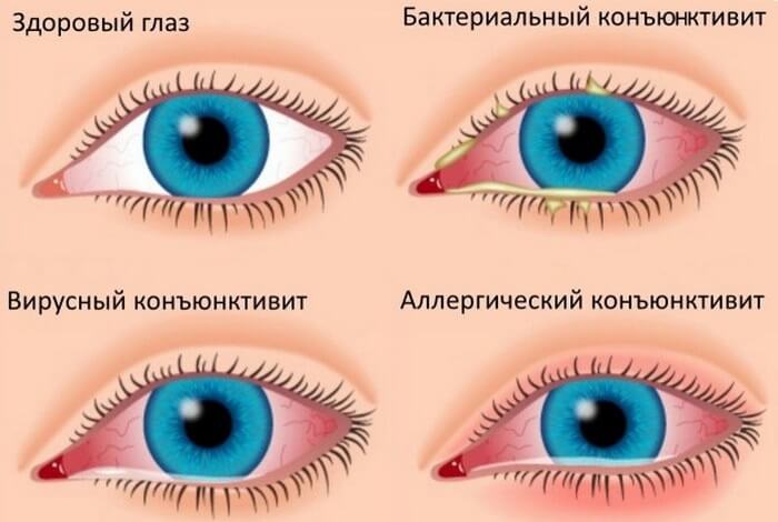 Основные виды конъюнктивита