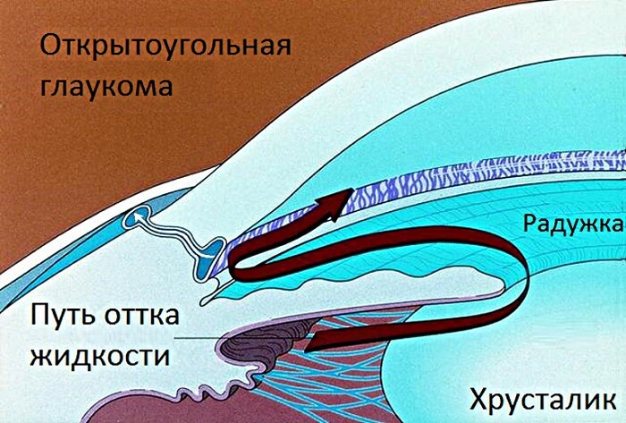 Открытоугольная глаукома у человека