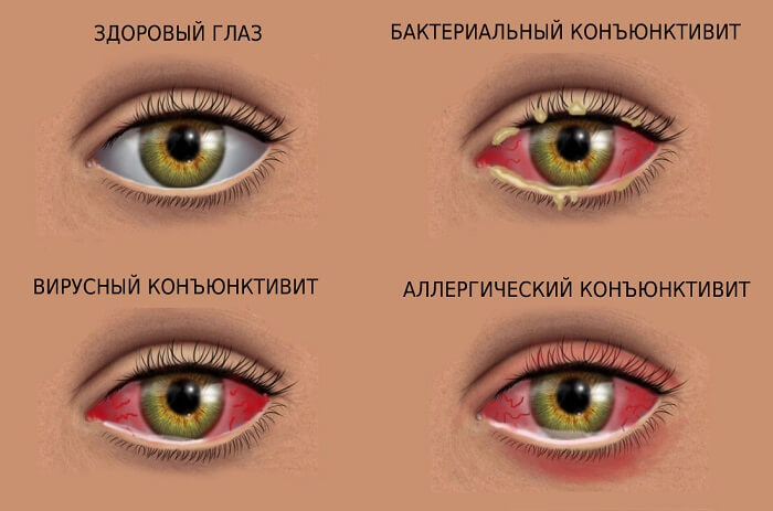 Покраснения глаза при конъюнктивите