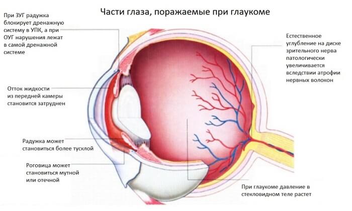 Поражение при глаукоме у человека