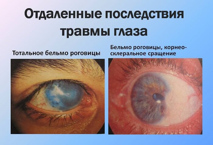 Последствия травмы глаза