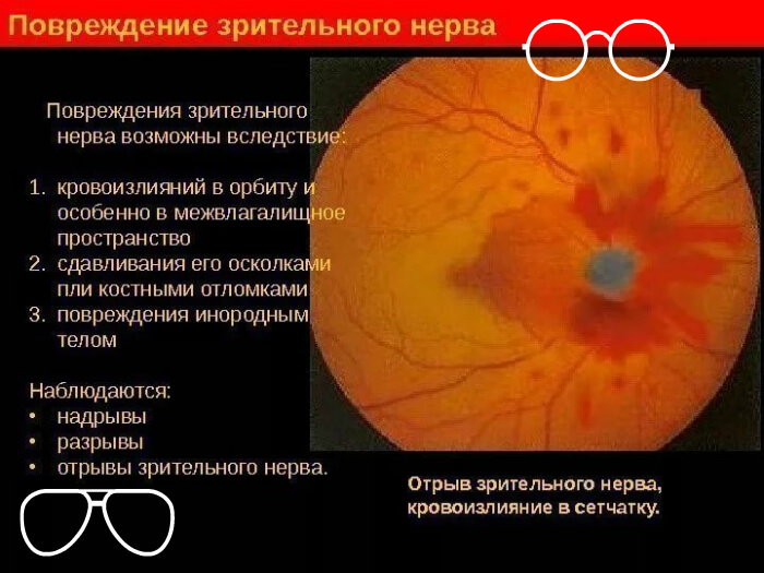 Повреждения зрительного нерва