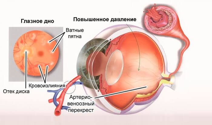 Повышенное давление в глазу