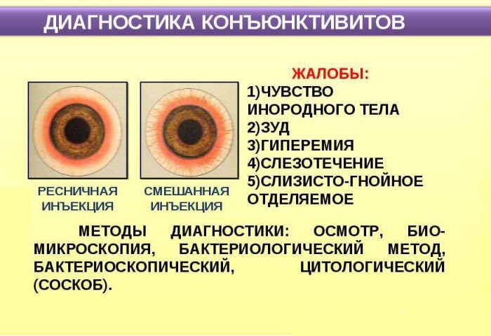 Правильная диагностика конъюнктивита