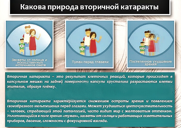 Природа вторичной катаракты