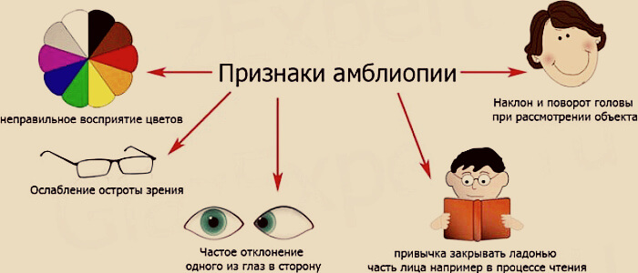 Признаки амблиопии глаз
