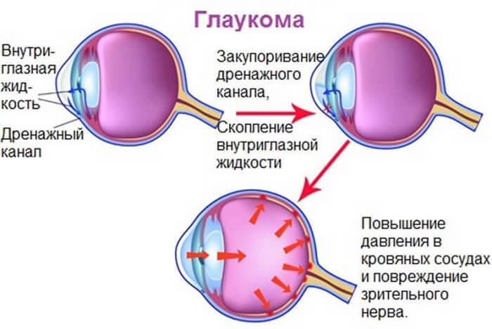Проявление глаукомы у человека