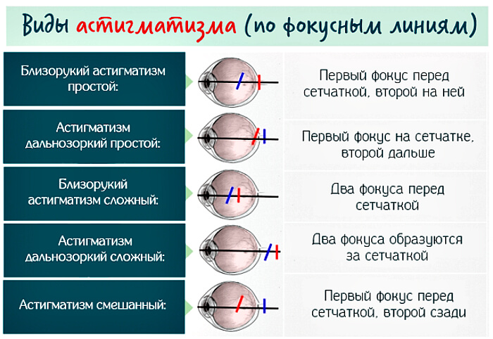 Различные виды астигматизма Разновидность по фокусным линиям