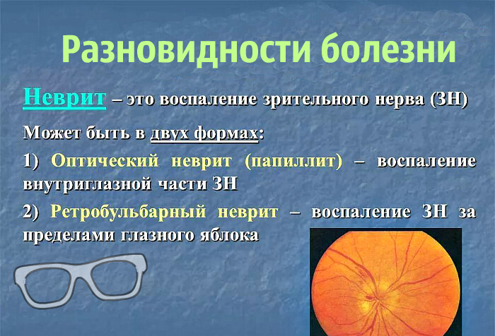 Разновидности зрительного неврита