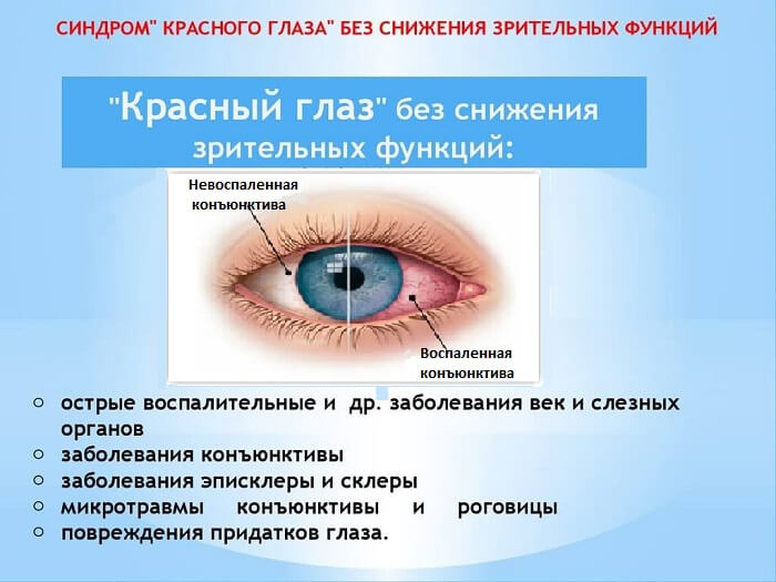 Синдром красного глаза
