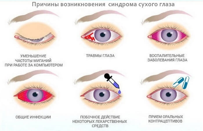 Синдром сухого глаза
