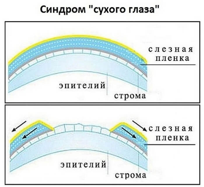 Синдром сухого глаза