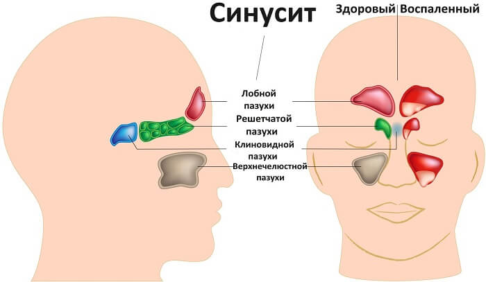 Синусит как причина слезотечения