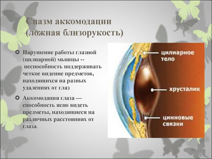 Спазм аккомодации глаза