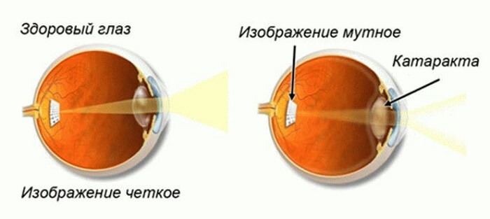 Сравнение глаз при катаракте