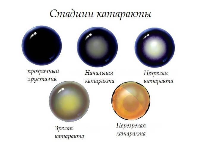 Основные стадии катаракты