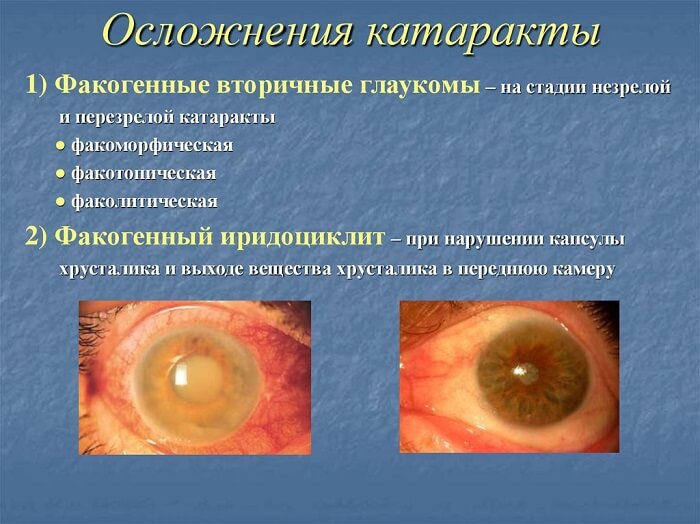 Стадии осложнения катаракты