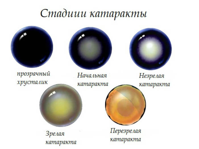 Стадии развития болезни