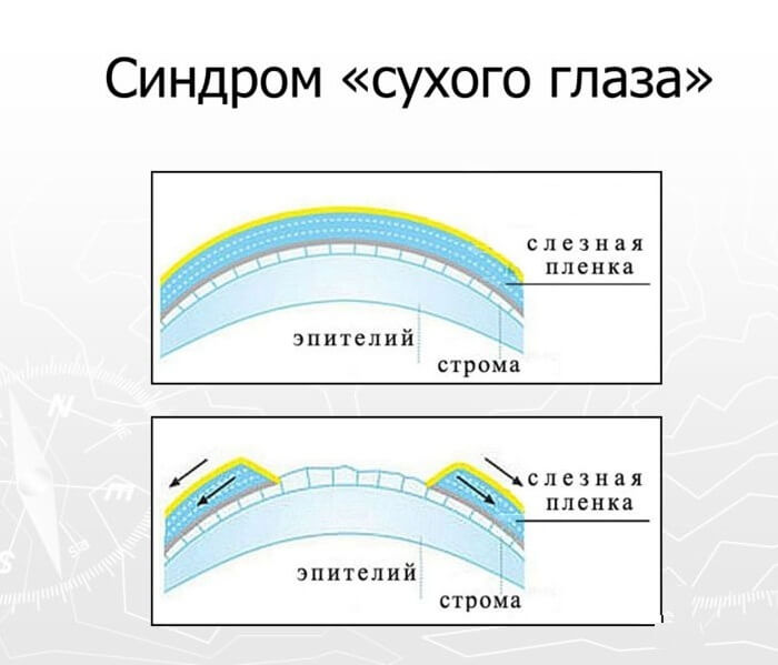 Сухой глаз у больного