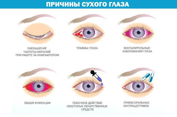 Сухой глаз у человека