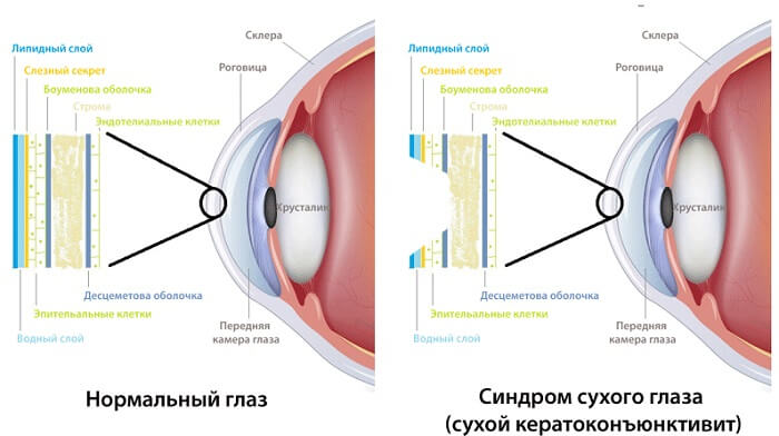 Сухой кератоконъюнктивит человека