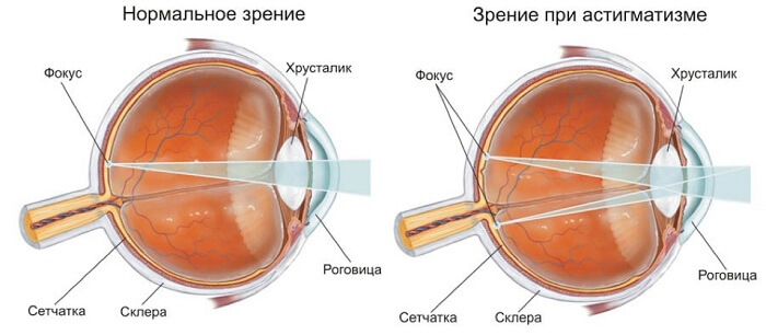 Астигматизм у человека