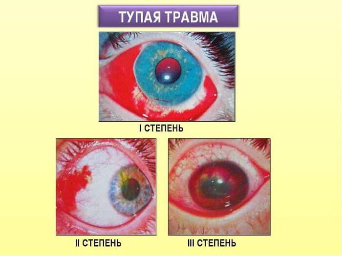 Тупая травма глаза