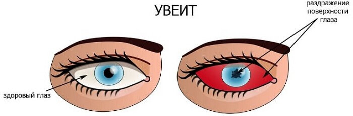 Увеит роговицы глаза