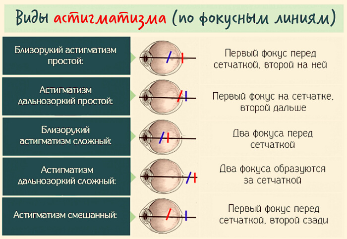 Виды астигматизма