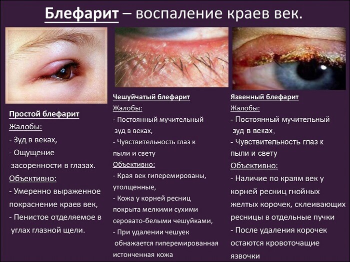 Виды блефарита