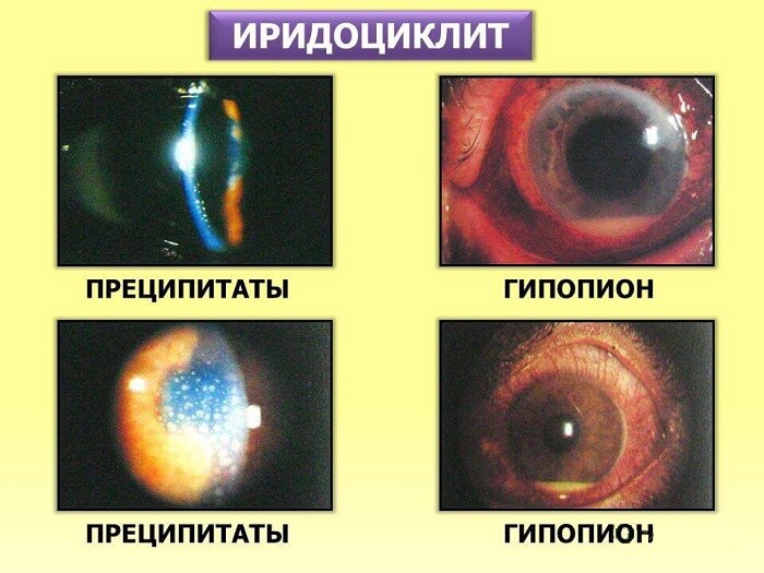 Виды иридоциклита