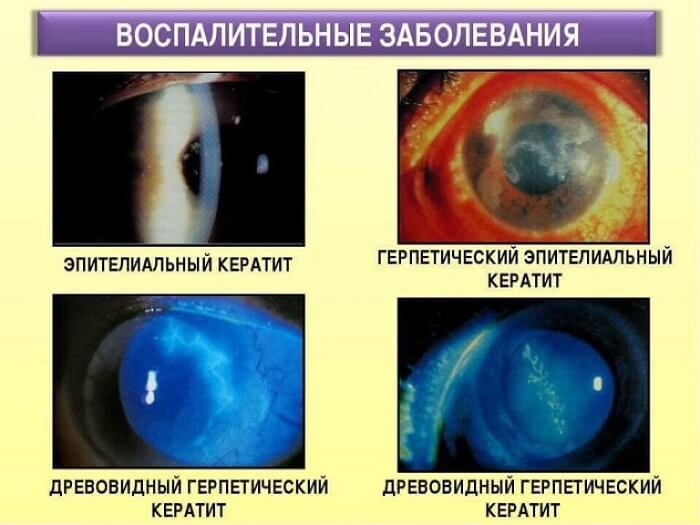 Виды кератита у человека