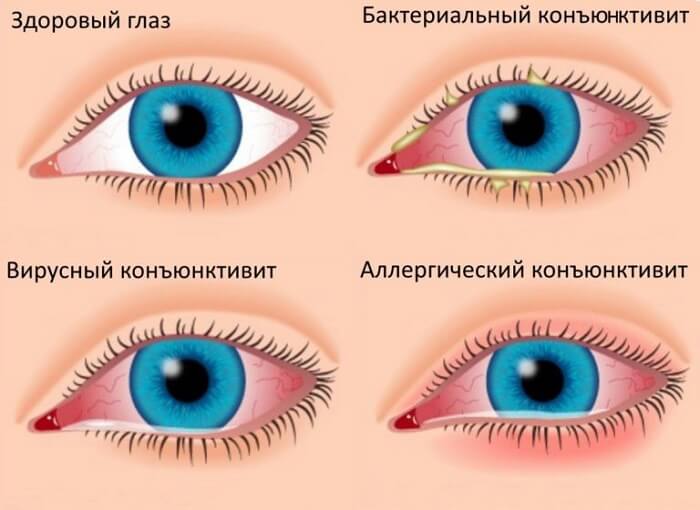Виды конъюнктивита у человека