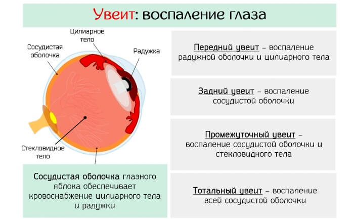 Воспаление глаза при увеите