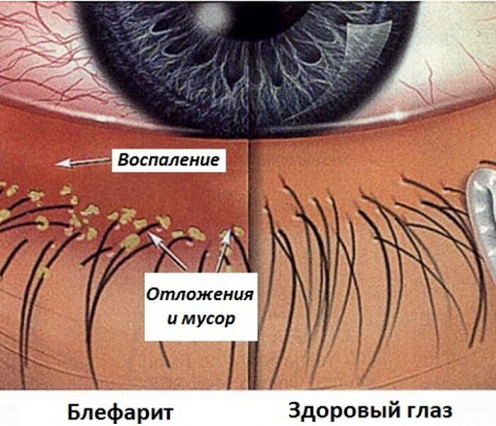 Воспаление глаза
