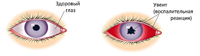 Воспаление переднего отдела