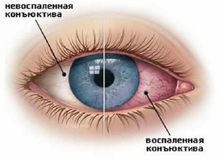 Воспаленная и не воспаленная конъюнктива