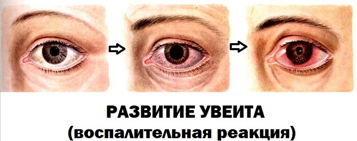 Воспалительная реакция глаза