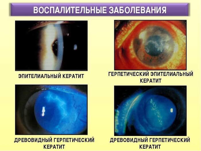 Воспалительные заболевания