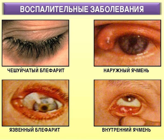 Воспалительные заболевания глаза
