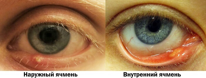 Ячмень на глазу у человека