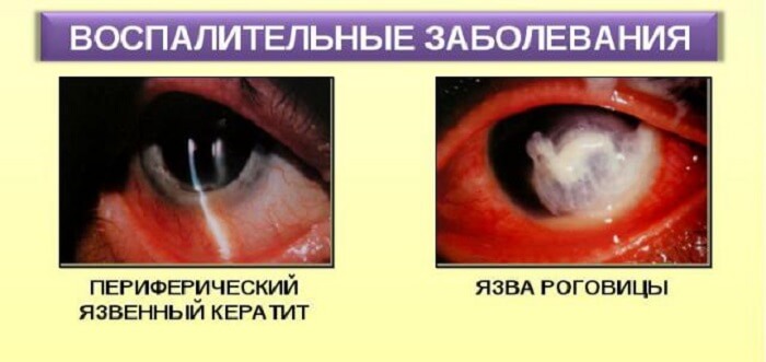 Язва роговицы глаза