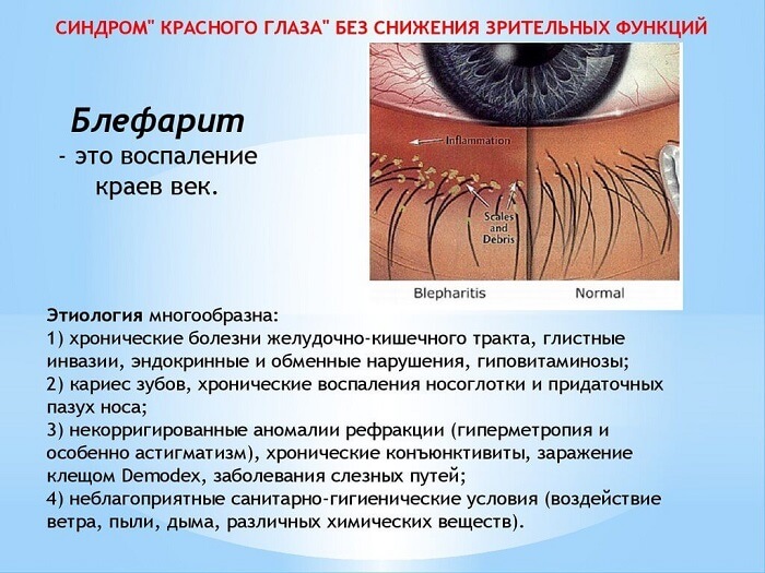 Заболевание блефарит глаза