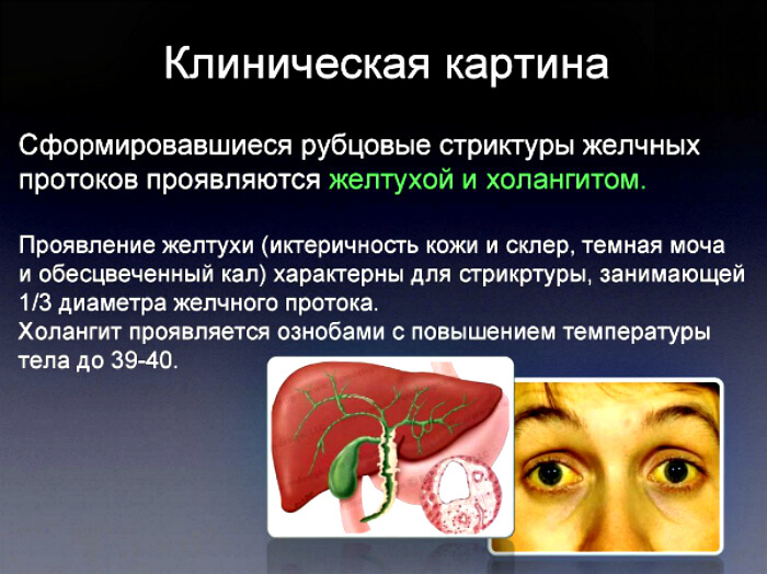 Заболевание протоков